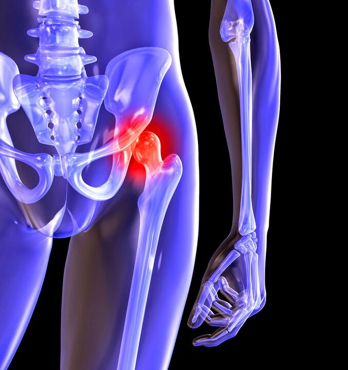 Deforming the arthrosis of the hip joint