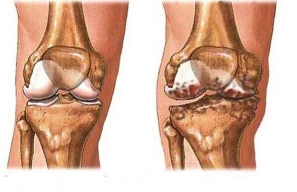 Healthy and painful wrist