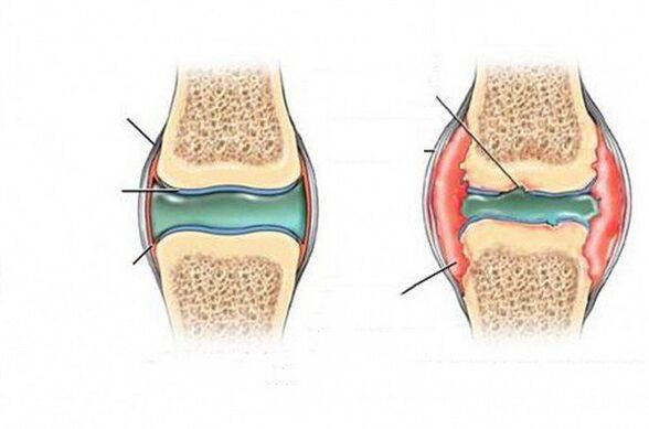 The process of deformation of the wrist