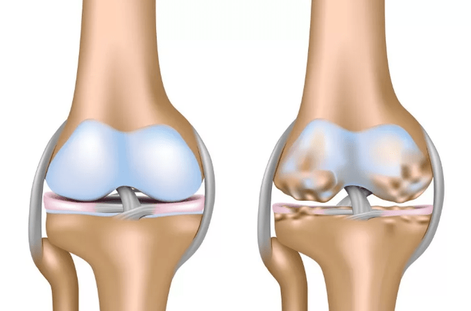 Deformation Arthrosis knee joint