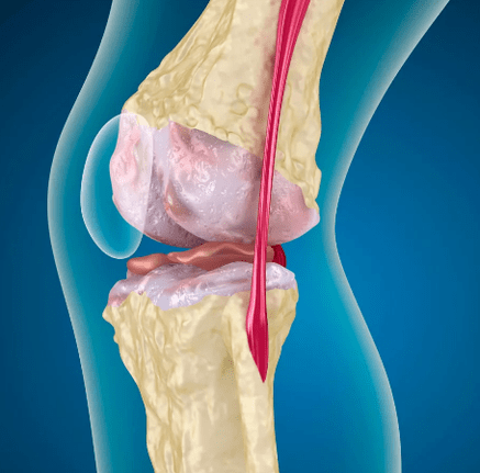 Knee wrist arthrososis